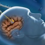 Cure tumori robot salva cervello4