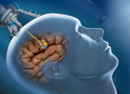 Cure tumori robot salva cervello