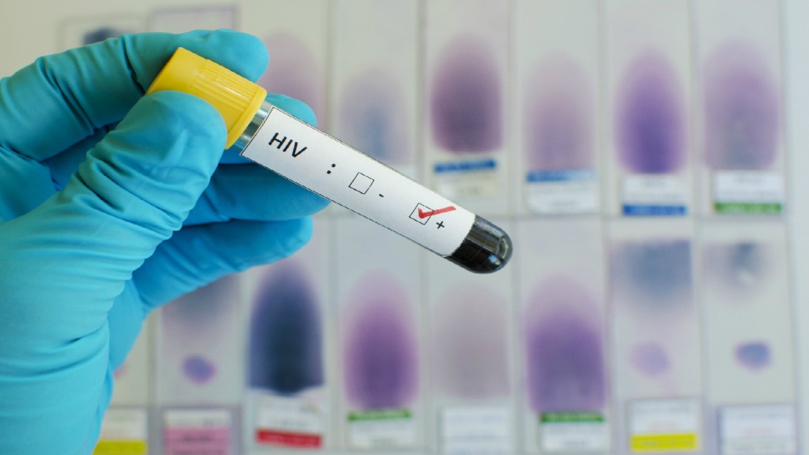 Aids sconfitto speranze concrete contro la peste dell’Hiv  